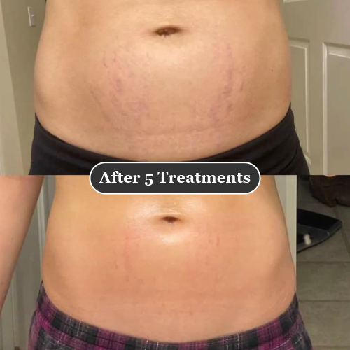 Clinical At Home Micro-Infusion System For Stretch Marks