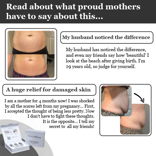 Clinical At Home Micro-Infusion System For Stretch Marks