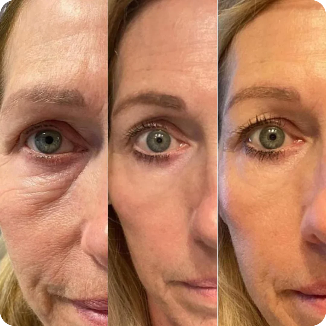Before and after results of a clinical micro needling system for home use on facial skin.