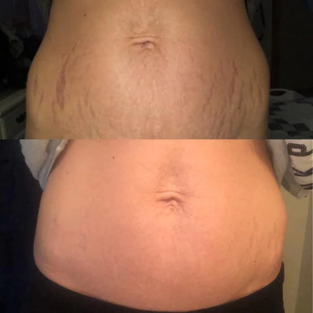 Testimonial voor Pregnancy Stretch Marks