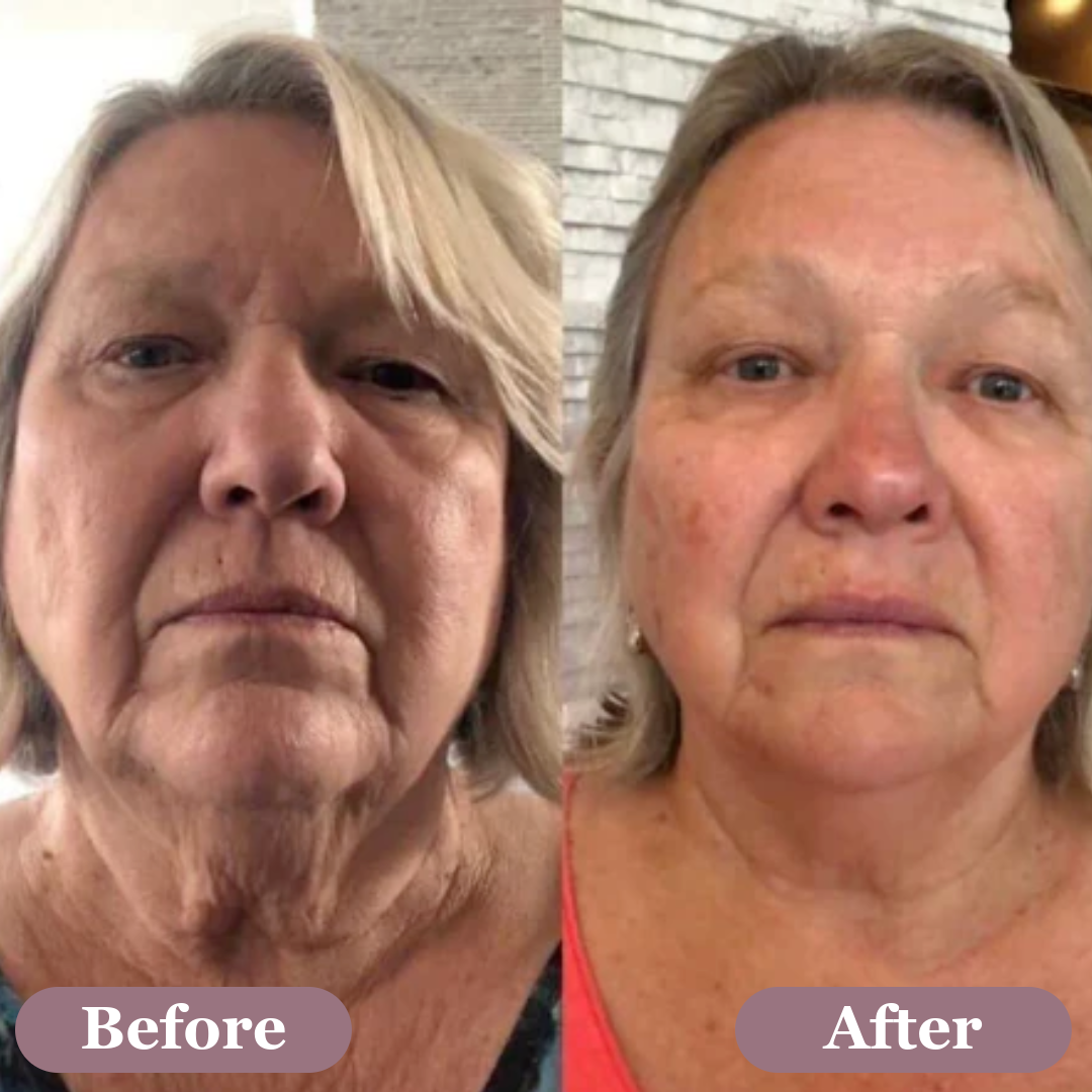 Before and after results of using a clinical micro-needling system for facial skin rejuvenation.
