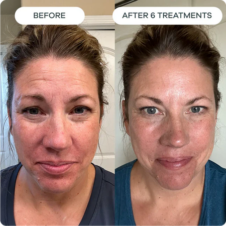 Testimonial voor Forehead Wrinkles & Frown Lines