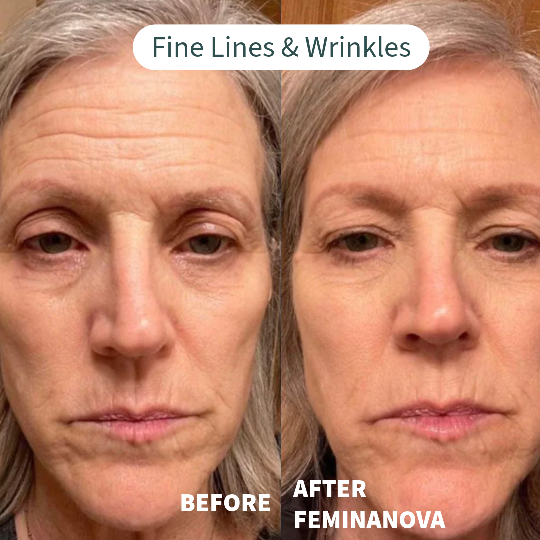 Before and after comparison of fine lines and wrinkles using Clinical At Home Treatment Look Years Younger In 5 Min BCFY.