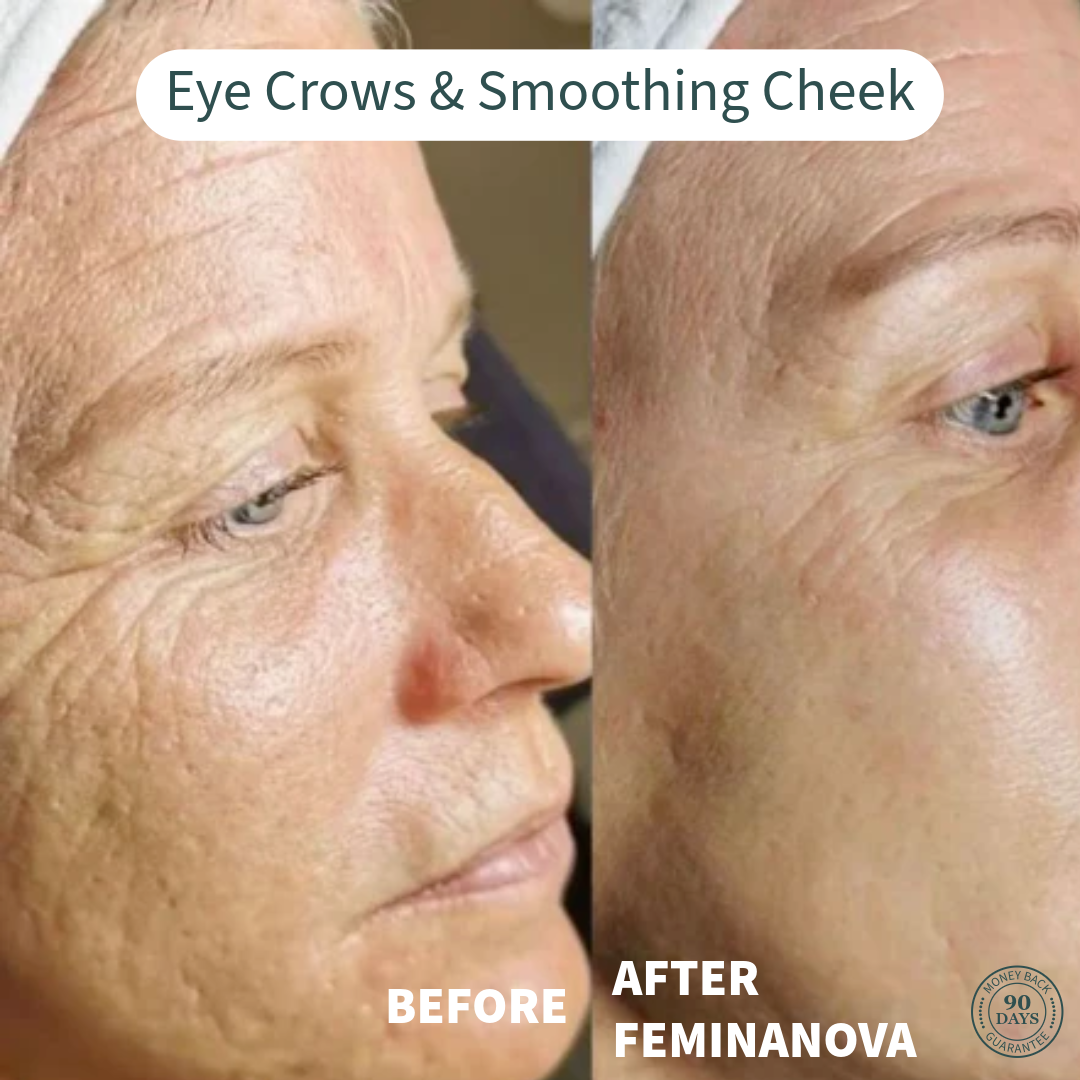 Eye Crows & Smoothing Cheek Before and After Results with Clinical At Home Treatment Look Years Younger In 5 Min BCFY.