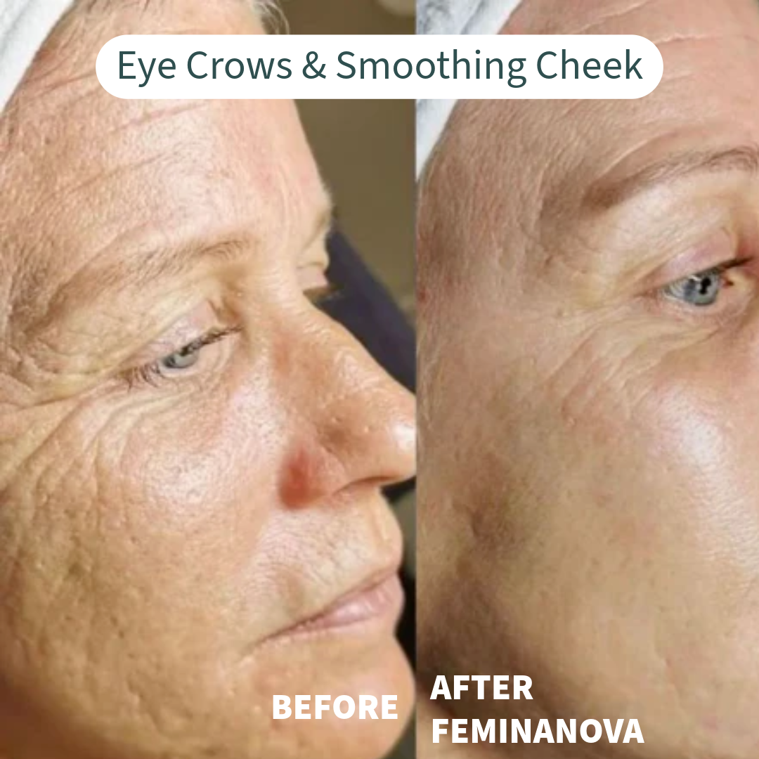 Eye Crows & Smoothing Cheek Before and After Clinical At Home Treatment Look Years Younger In 5 Min BCFY