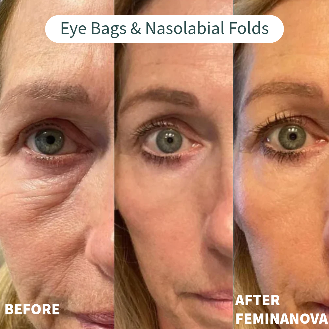 Image showing before and after results of Clinical At Home Treatment Look Years Younger In 5 Min BCFY for eye bags and nasolabial folds.