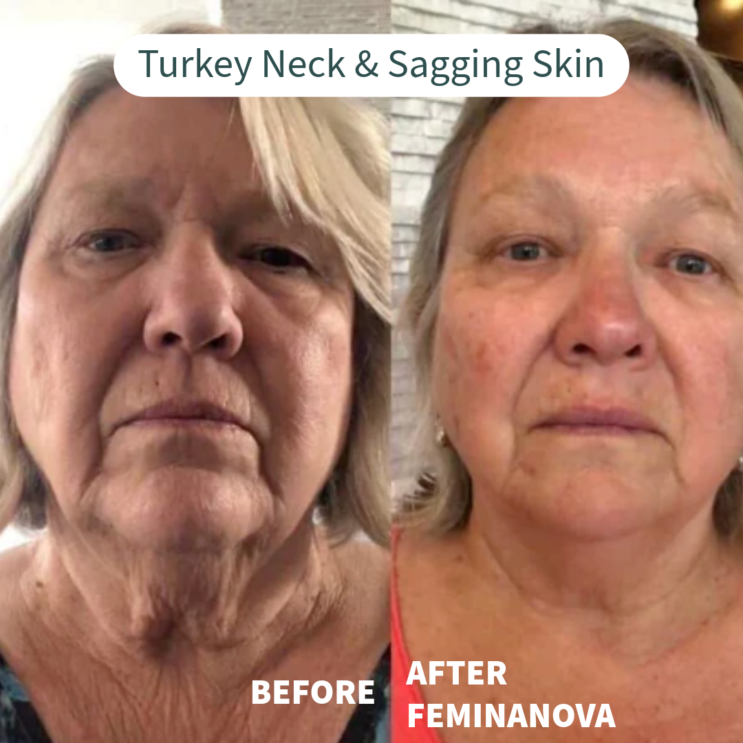 Before and after image showing results for Turkey Neck & Sagging Skin with Clinical At Home Treatment Look Years Younger In 5 Min BCFY.
