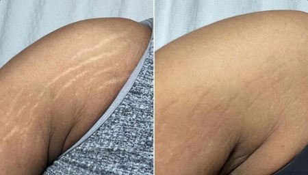 Testimonial voor Weight-Loss Stretch Marks On Arms